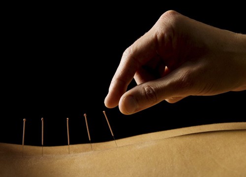 การฝังเข็ม-Acupuncture-คืออะไรedit